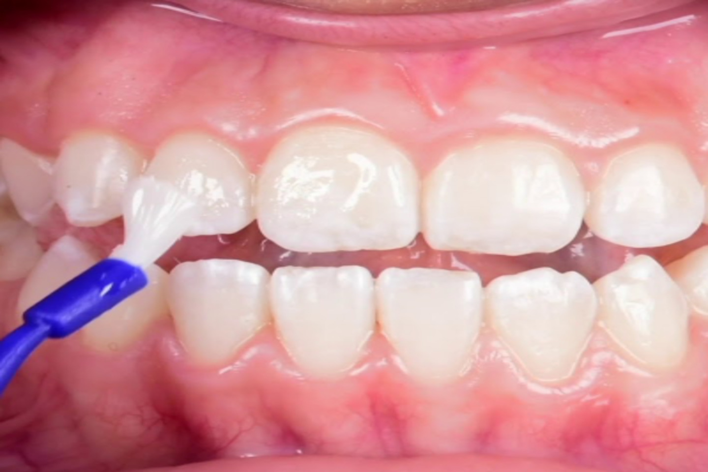 Remineralización Post-Blanqueamiento